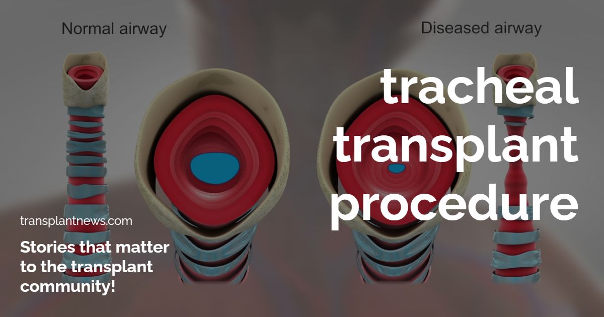 Tracheal Transplant Procedure