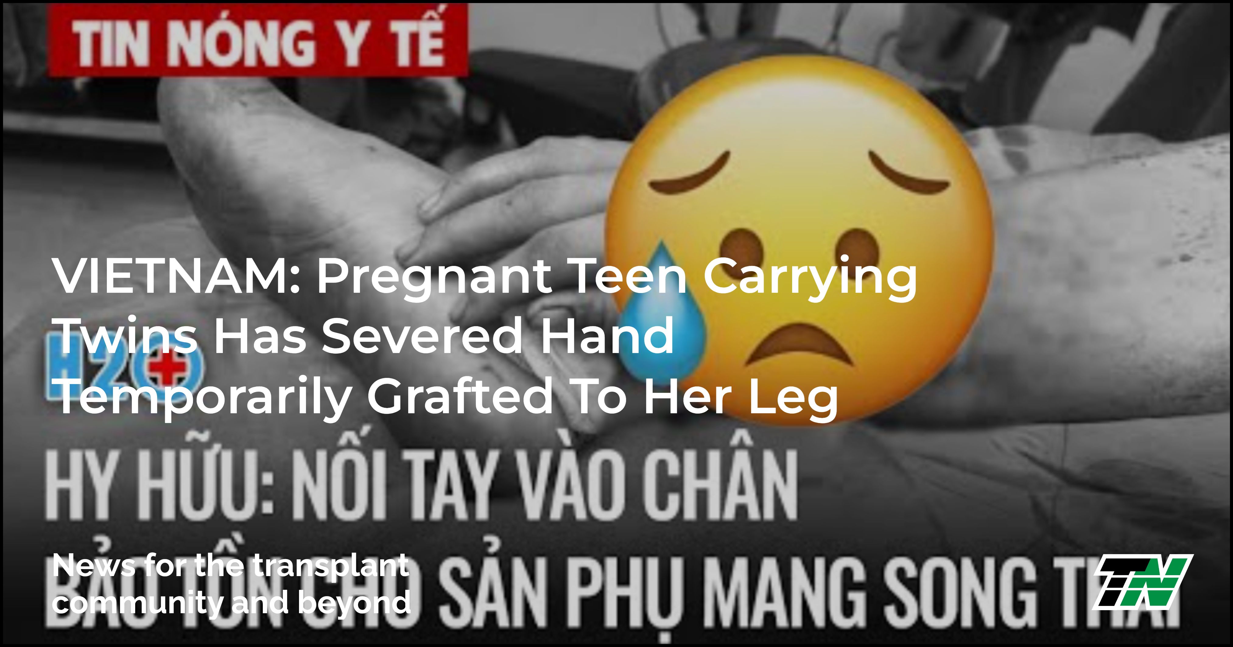 VIETNAM: Pregnant Teen Carrying Twins Has Severed Hand Temporarily Grafted To Her Leg